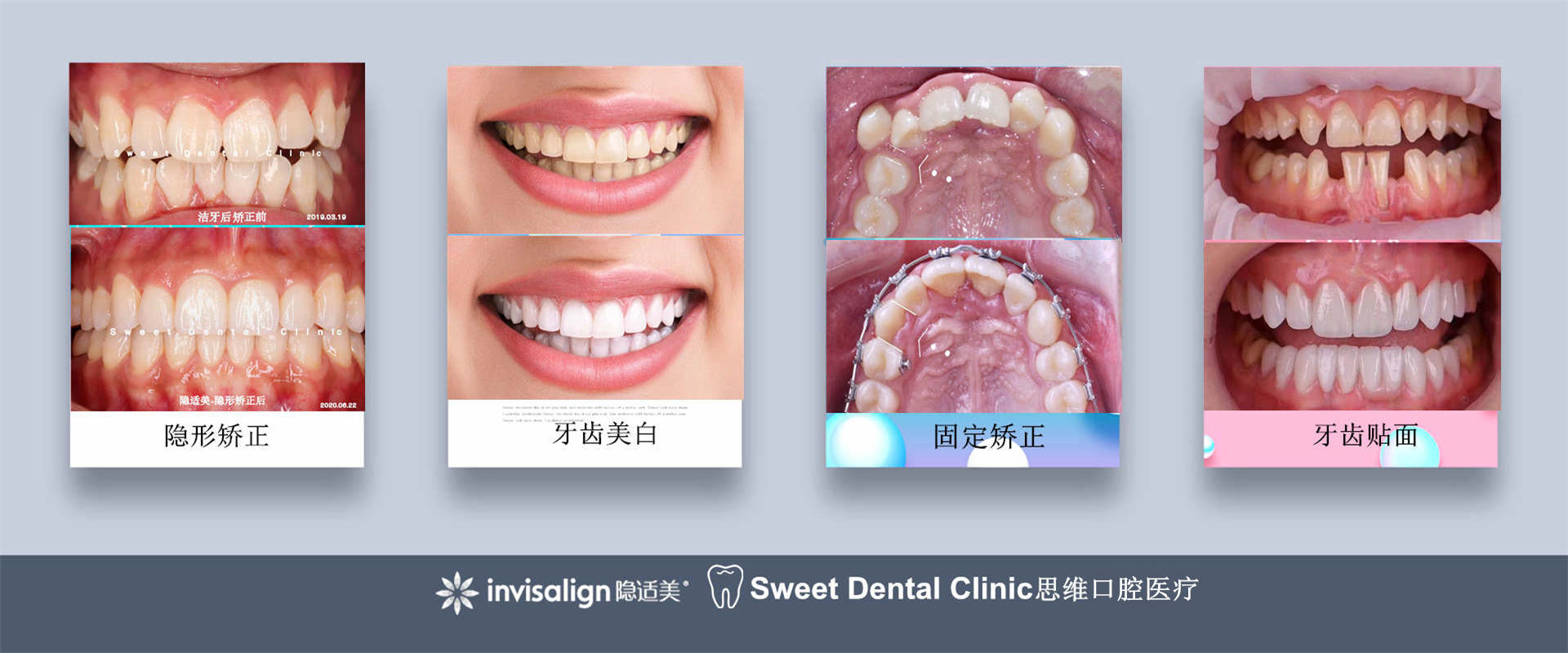 金属托槽矫正案例